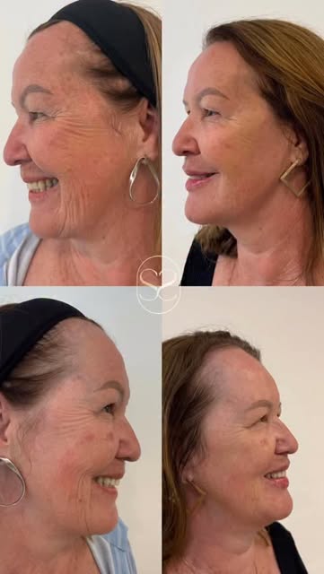 Harmonização facial: antes e depois em vista de perfil