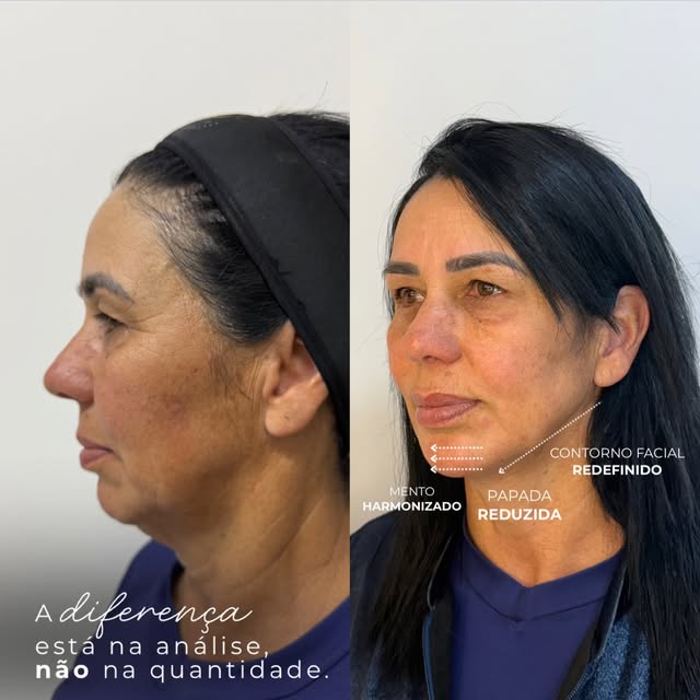 Contorno facial redefinido: antes e depois com mento harmonizado