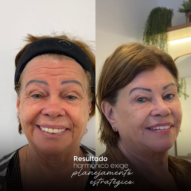 Paciente com mais de 70 anos: resultado gradual e natural, antes e depois